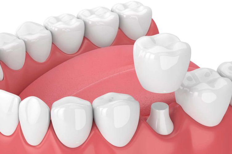 dental-crown-bridge